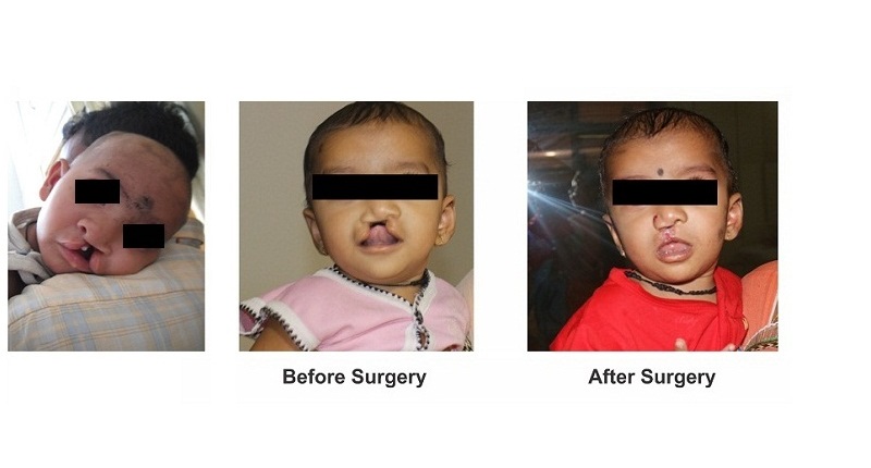 cleft lip and palate surgery in Pune
